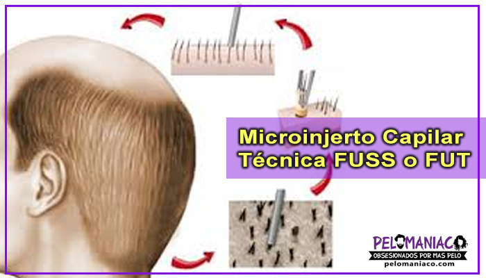 Microinjerto capilar tecnica fut o fuss